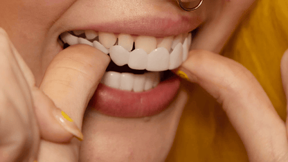 Removable Resin Full-Arch Snap-On Veneers