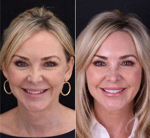 Removable Resin Full-Arch Snap-On Veneers