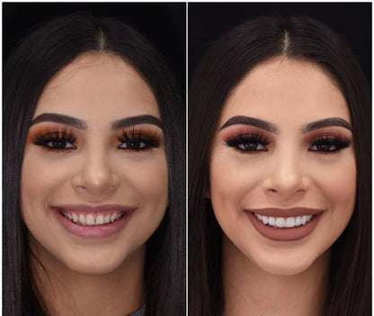 Removable Resin Full-Arch Snap-On Veneers