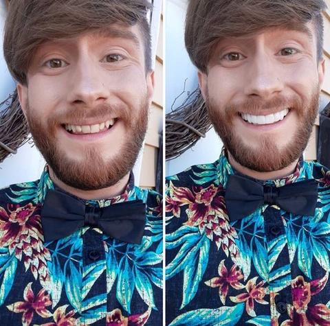 Removable Resin Full-Arch Snap-On Veneers